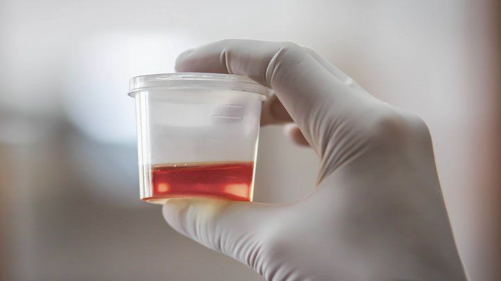 What Causes Blood in Urine (Hematuria)?