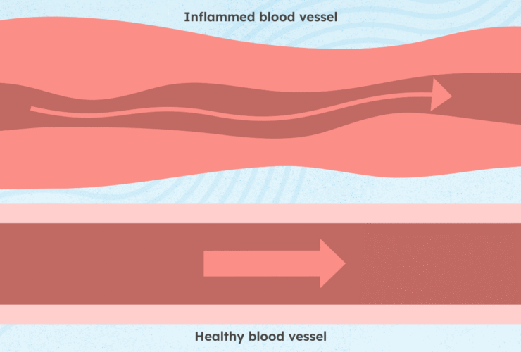 What Is ANCA-Associated Vasculitis (AAV)?