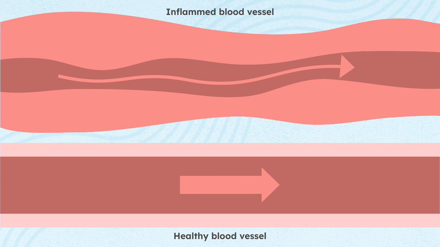 What Is ANCA-Associated Vasculitis (AAV)?