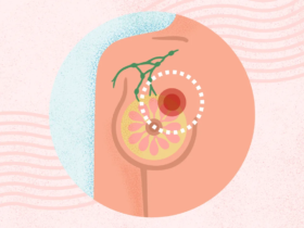 What Is Breast Cancer? Symptoms, Causes, Diagnosis, Treatment, and Prevention