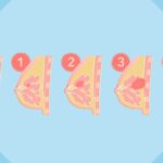 Breast Cancer Stages 0–4: What They Mean