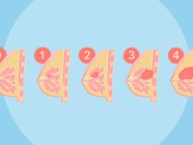 Breast Cancer Stages 0–4: What They Mean