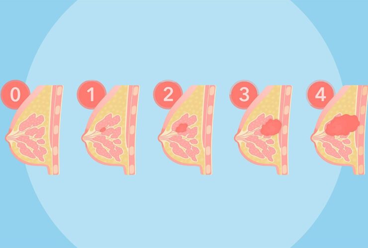 Breast Cancer Stages 0–4: What They Mean