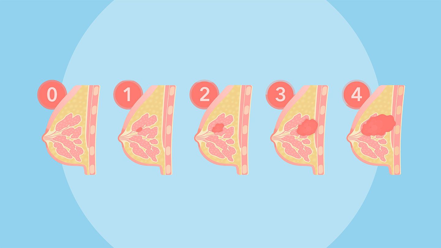 Breast Cancer Stages 0–4: What They Mean