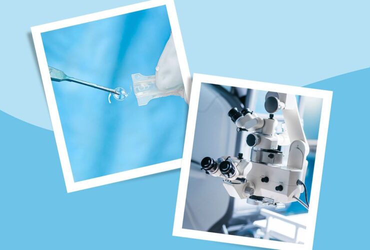 Surgery for Cataracts