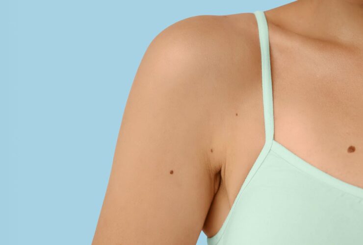 Why Does My Mole Have a Hair Growing Out of It?