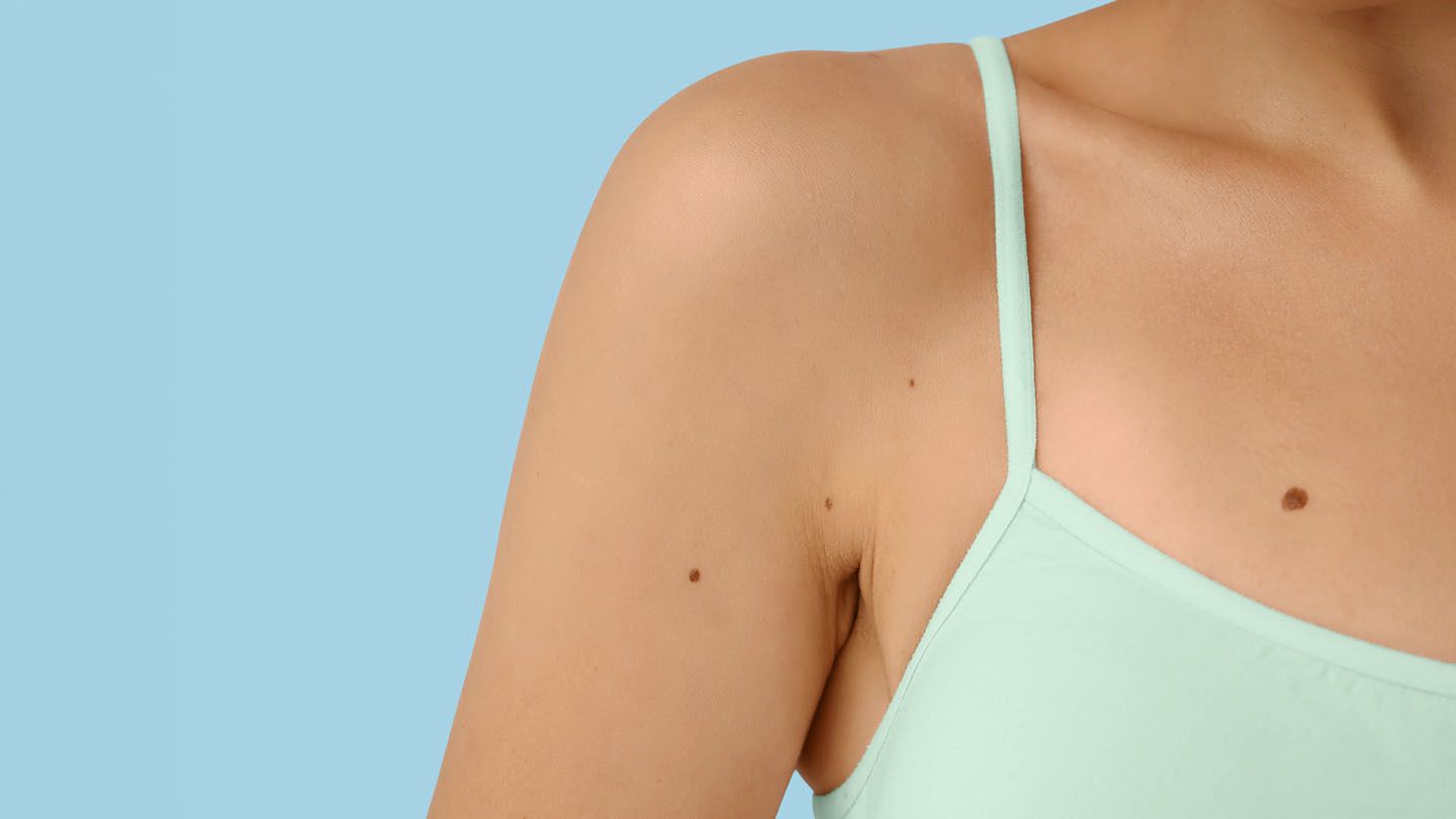 Why Does My Mole Have a Hair Growing Out of It?