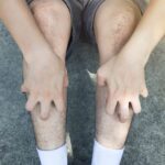 Why Your Lower Legs Might Feel Itchy and How to Stop It