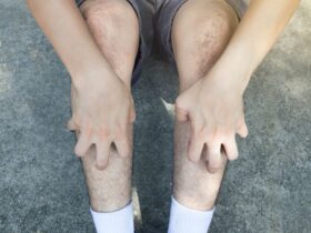 Why Your Lower Legs Might Feel Itchy and How to Stop It