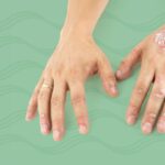A Drug Combo That Includes a GLP-1 May Improve Psoriasis and Psoriatic Arthritis Symptoms
