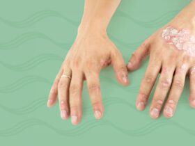 A Drug Combo That Includes a GLP-1 May Improve Psoriasis and Psoriatic Arthritis Symptoms