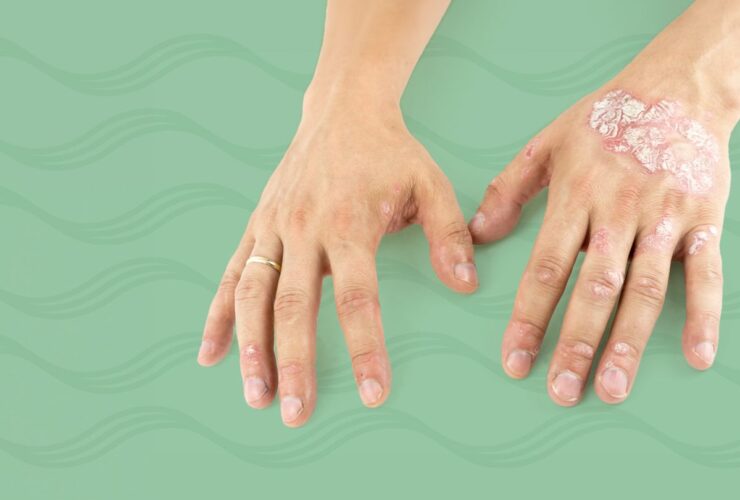 A Drug Combo That Includes a GLP-1 May Improve Psoriasis and Psoriatic Arthritis Symptoms