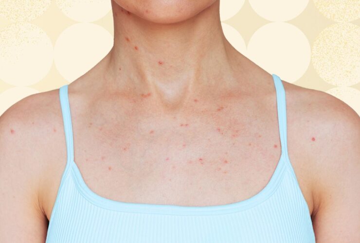 5 Places Body Acne Can Show Up and What to Do About It