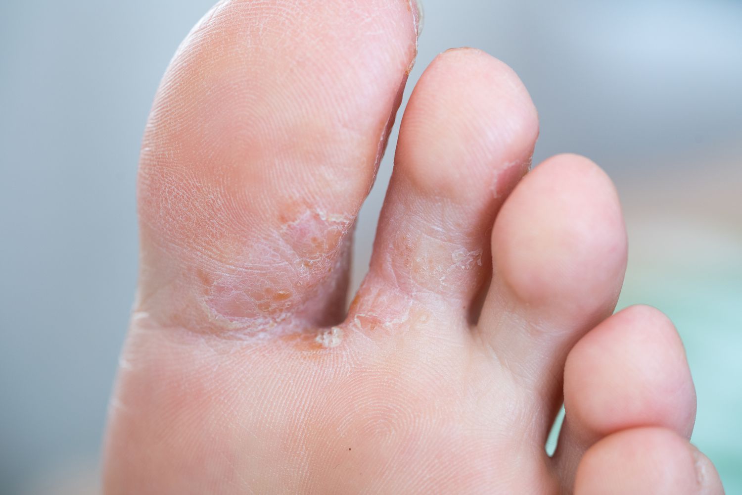 7 Reasons You May Have Skin Peeling Between Your Toes