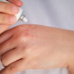 8 Hand Rash Causes and What Treatments Help