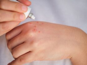 8 Hand Rash Causes and What Treatments Help
