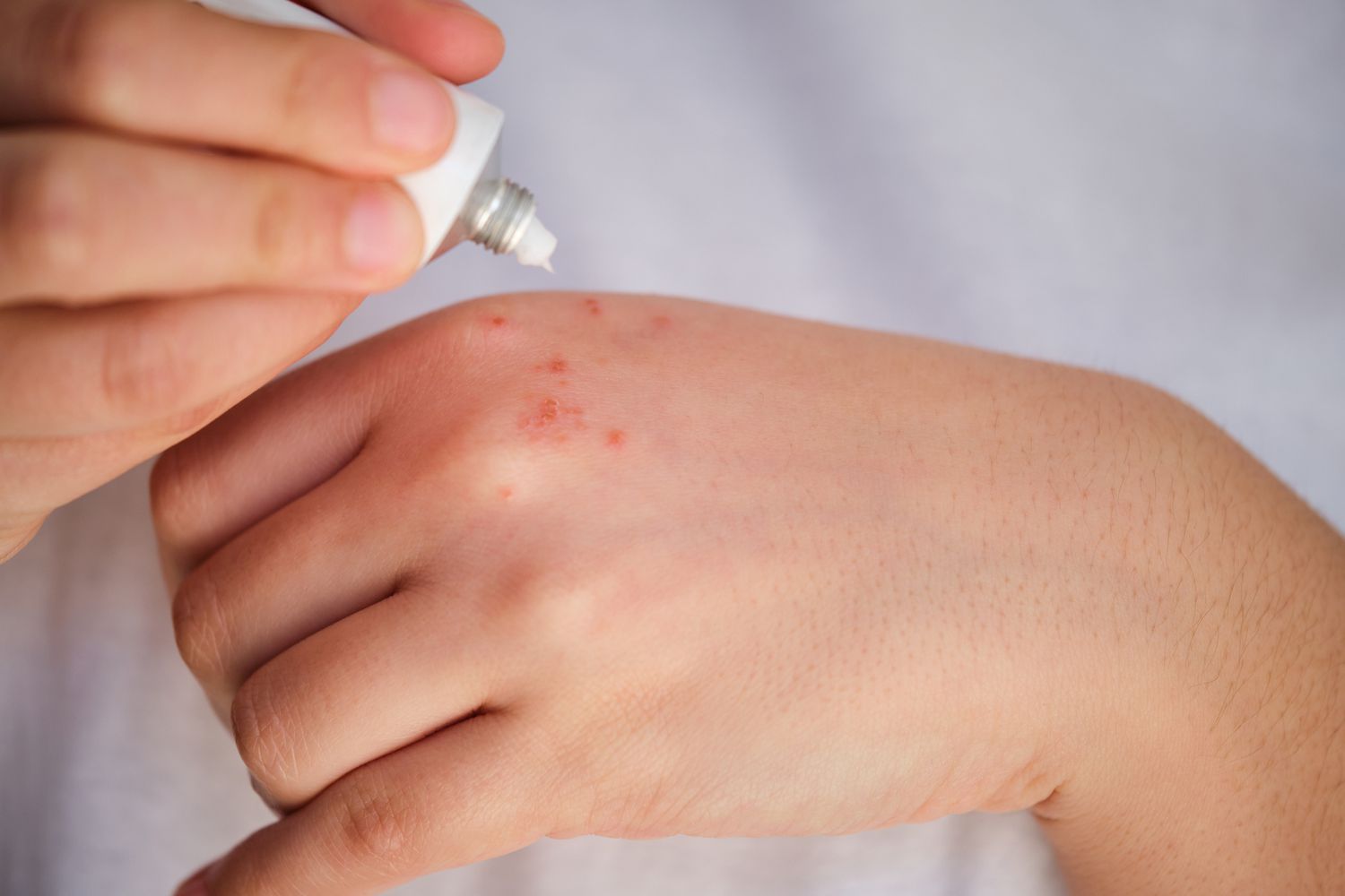 8 Hand Rash Causes and What Treatments Help