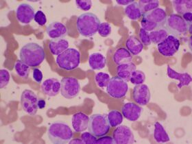Acute Myeloid Leukemia Survival Rates and Outlook