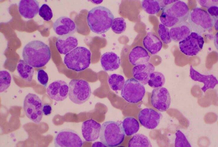 Acute Myeloid Leukemia Survival Rates and Outlook