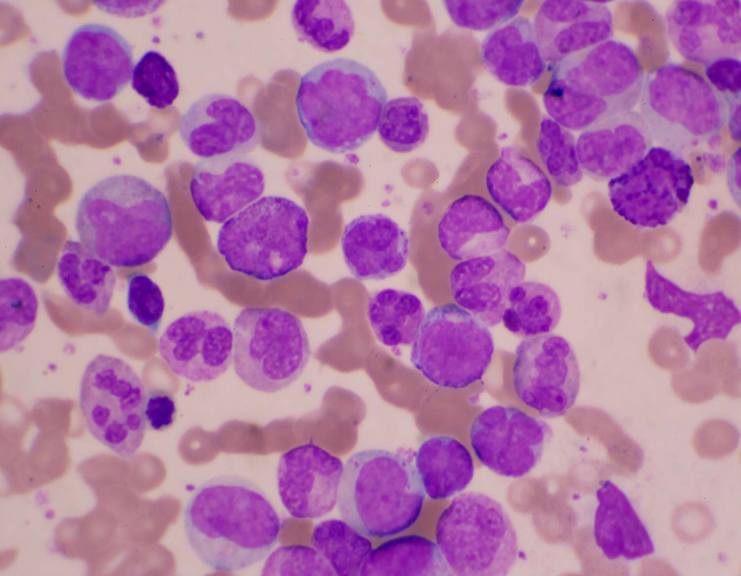 Acute Myeloid Leukemia Survival Rates and Outlook