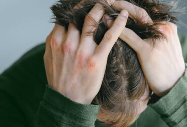 Atopic Dermatitis Treatment Burnout Is a Real Thing