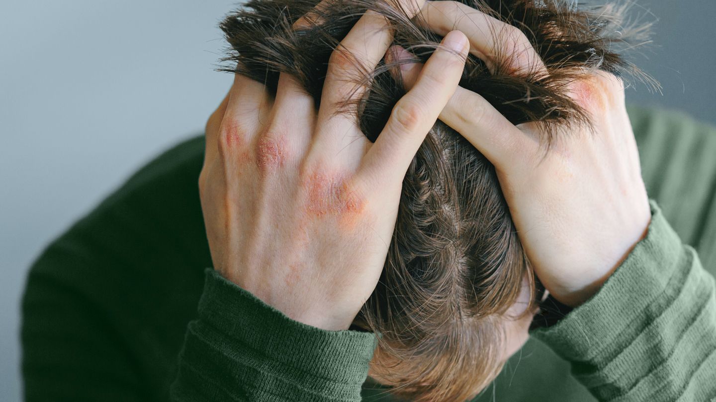 Atopic Dermatitis Treatment Burnout Is a Real Thing