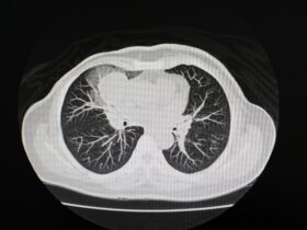 Automated CT scan analysis could fast-track clinical assessments