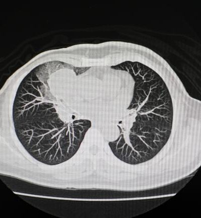 Automated CT scan analysis could fast-track clinical assessments