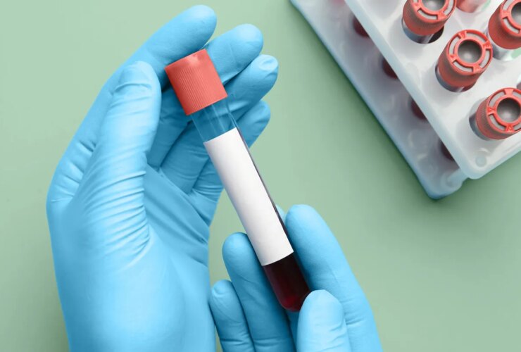 Blood Test May Predict Dementia in Women 25 Years Before Symptoms Appear