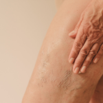 Crepey Skin On The Legs: Causes, Treatments & More