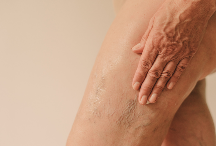 Crepey Skin On The Legs: Causes, Treatments & More