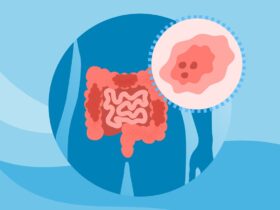 What Is Early-Onset Colorectal Cancer?