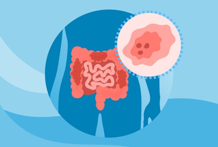 What Is Early-Onset Colorectal Cancer?