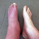 Erythromelalgia: A Very Rare Condition