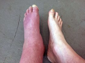 Erythromelalgia: A Very Rare Condition