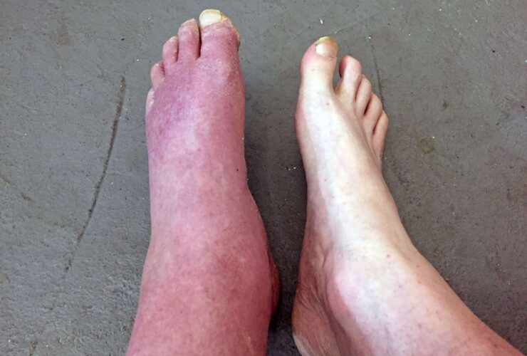 Erythromelalgia: A Very Rare Condition