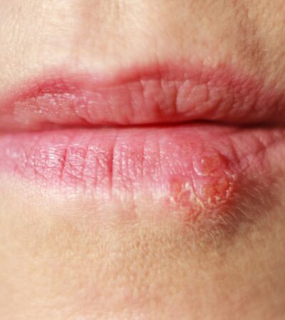 How Contagious Is HSV-1 Genitally?