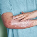 9 Psoriasis ‘Mistakes’ and How to Avoid Them