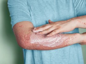 9 Psoriasis ‘Mistakes’ and How to Avoid Them