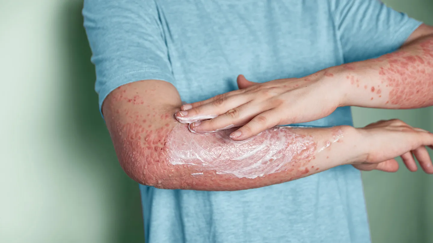 9 Psoriasis ‘Mistakes’ and How to Avoid Them