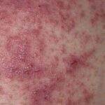 How to Spot a Gluten Rash With Photos
