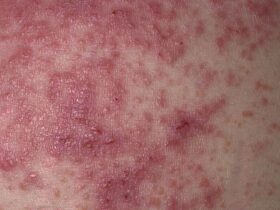 How to Spot a Gluten Rash With Photos