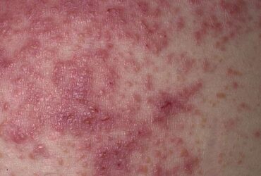 How to Spot a Gluten Rash With Photos