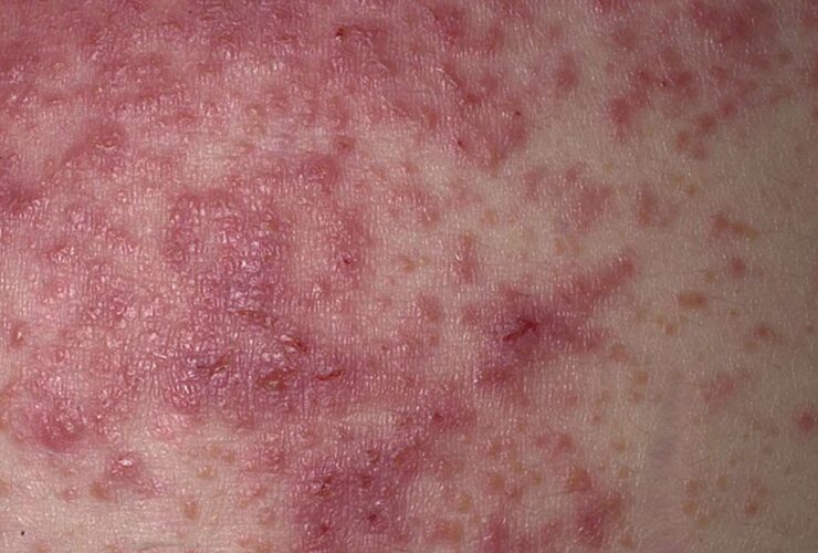 How to Spot a Gluten Rash With Photos