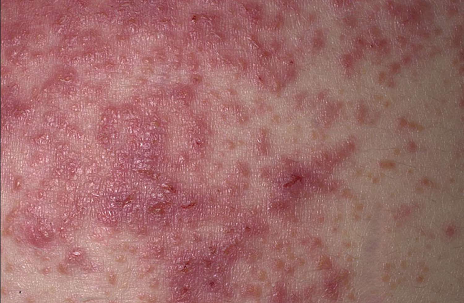 How to Spot a Gluten Rash With Photos