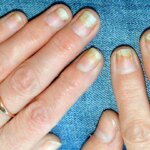 How to Treat Nail Damage From Psoriatic Arthritis