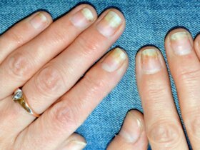 How to Treat Nail Damage From Psoriatic Arthritis