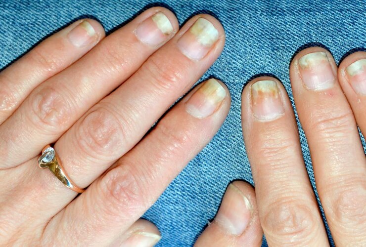 How to Treat Nail Damage From Psoriatic Arthritis