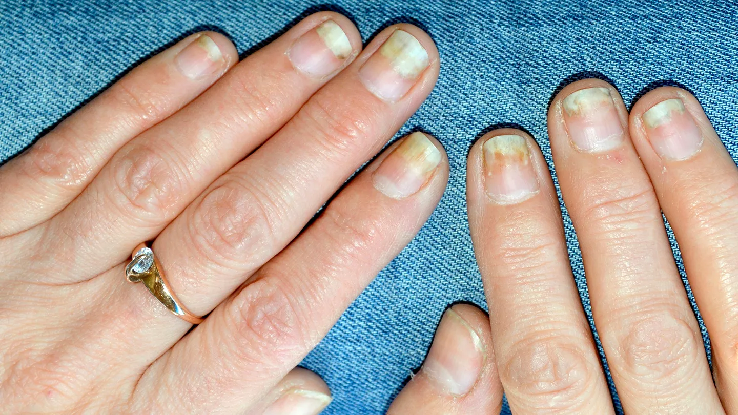 How to Treat Nail Damage From Psoriatic Arthritis