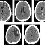 Immuno-molecular features and therapeutic implications of brain metastases in clear cell renal cell carcinoma patients